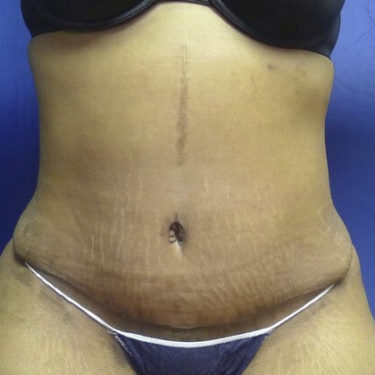 Tummy Tuck in Northern Virginia - Timothy Mountcastle, M.D.