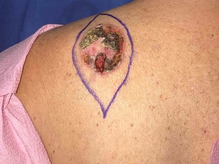 Skin Cancer before VA