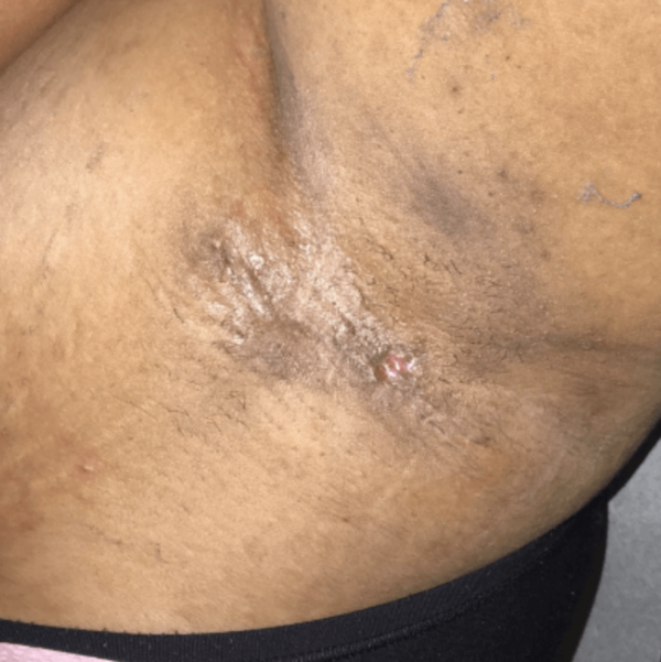 Hidradenitis excision after VA