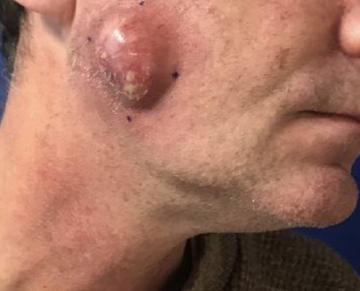 Cyst – Sebaceous removal before VA