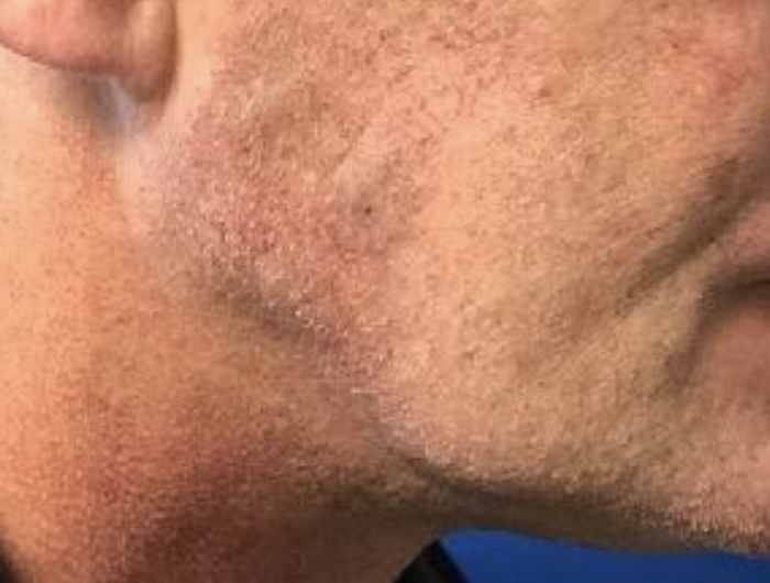 Cyst – Sebaceous removal after VA