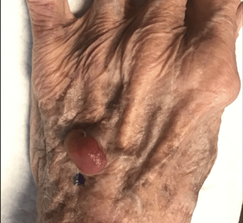 Melanoma before VA