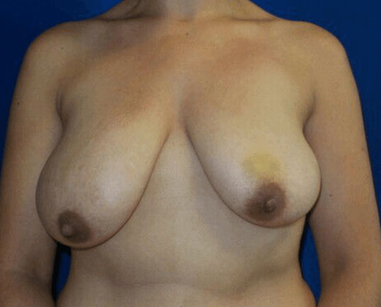 Breast augmentation before and after image.