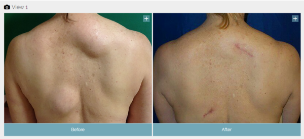 lipoma before and after VA