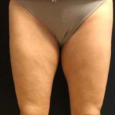 Before & After CoolSculpting Inner Thighs Photos - Timothy