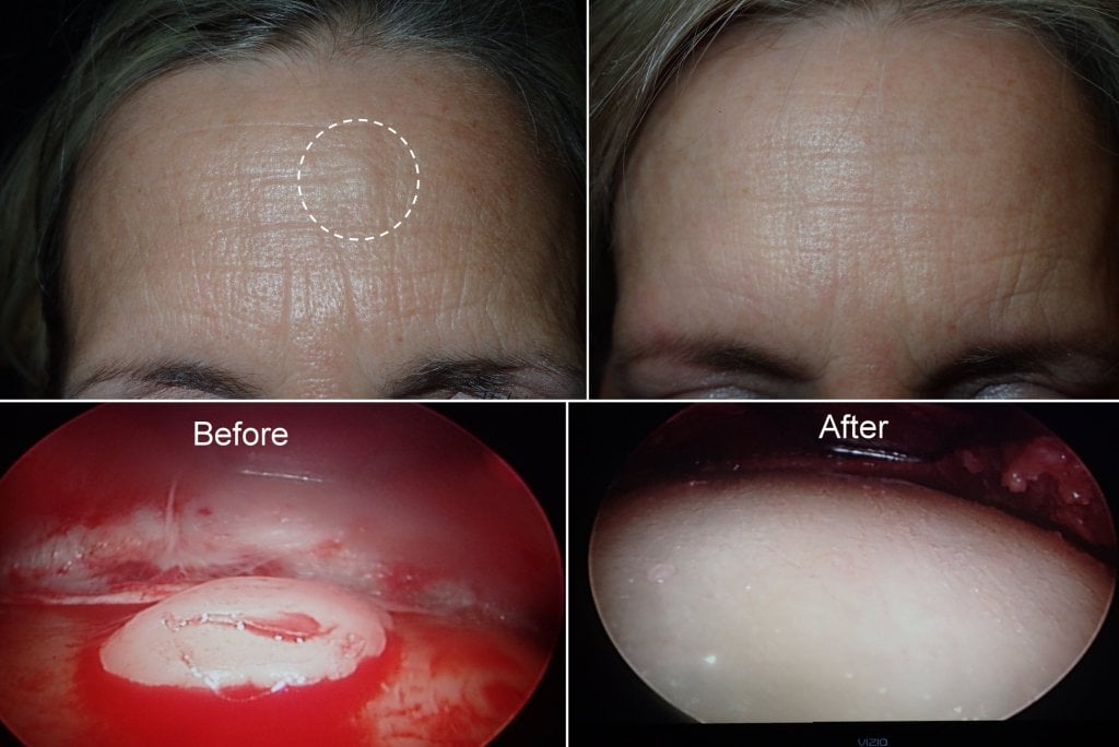 osteoma befoer and after surgery