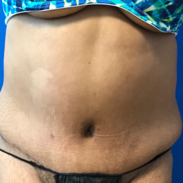 Tummy Tuck in Northern Virginia - Timothy Mountcastle, M.D.