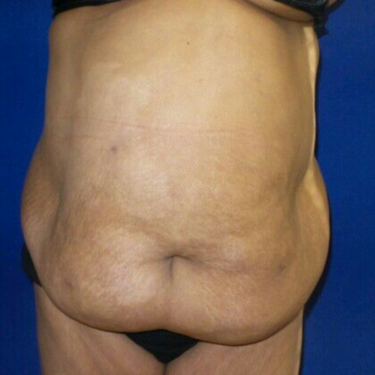 Panniculectomy Before And After Photo Gallery