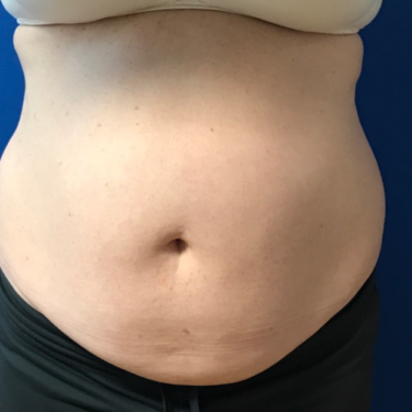 Tummy Tuck in Northern Virginia - Timothy Mountcastle, M.D.