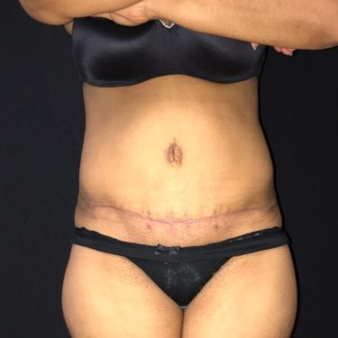 Tummy Tuck in Northern Virginia - Timothy Mountcastle, M.D.