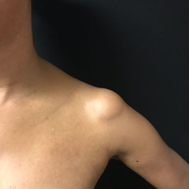 Lipoma Removal Before & After Photos - Timothy Mountcastle, M.D.