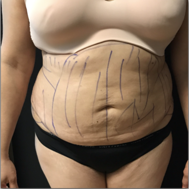 Liposuction - Abdomen / Flanks Before and After Photo Gallery, Coeur  d'Alene, ID