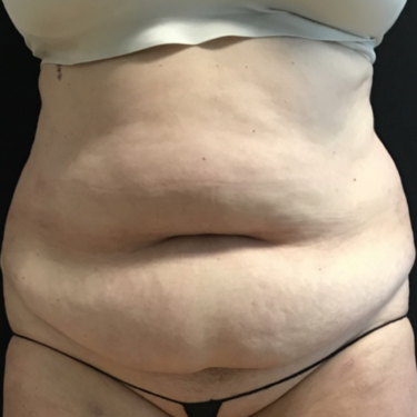 Tummy Tuck in Northern Virginia - Timothy Mountcastle, M.D.