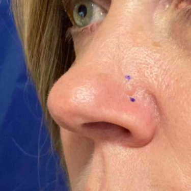 Before After Basal Cell Carcinoma Left Nose Photos Timothy