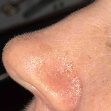 basal cell carcinoma nose scar